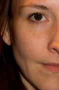BEFORE Picture - Garnier Skin Renew Clinical Dark Spot Overnight Peel