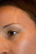 BEFORE Picture - Garnier Skin Renew Clinical Dark Spot Overnight Peel